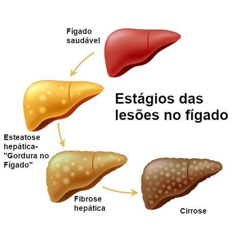 doenças do figado - rei do brasil